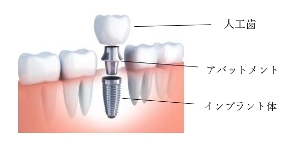 インプラントオペ