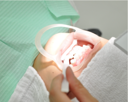 オフィスホワイトニング