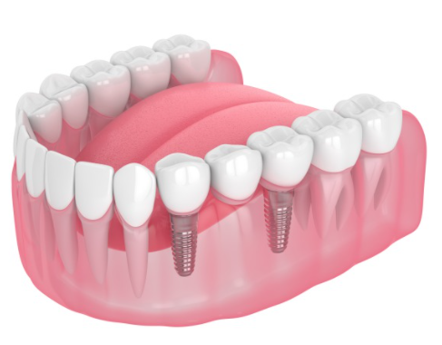 上部構造（人口歯）セット