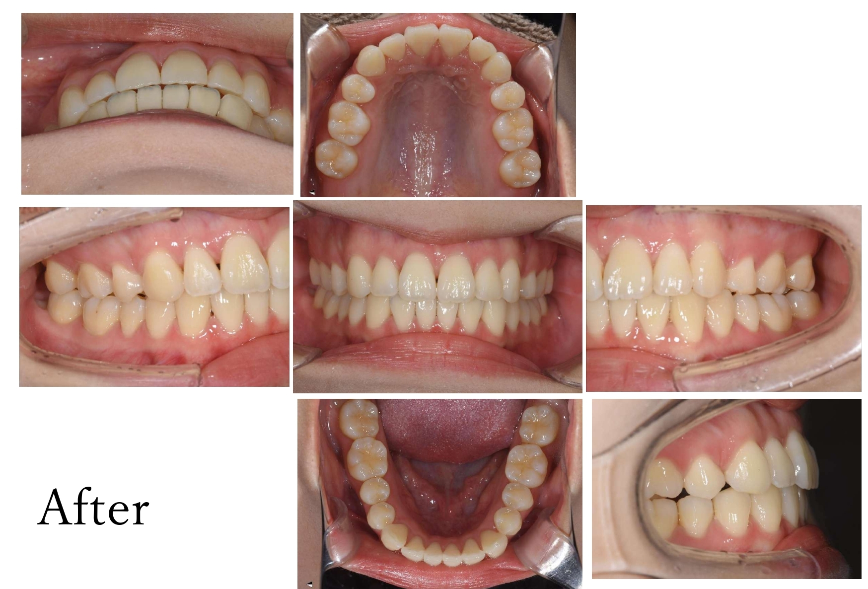 矯正治療 After