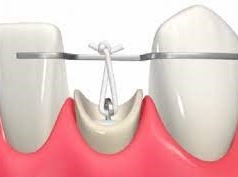 エクストリュージョン