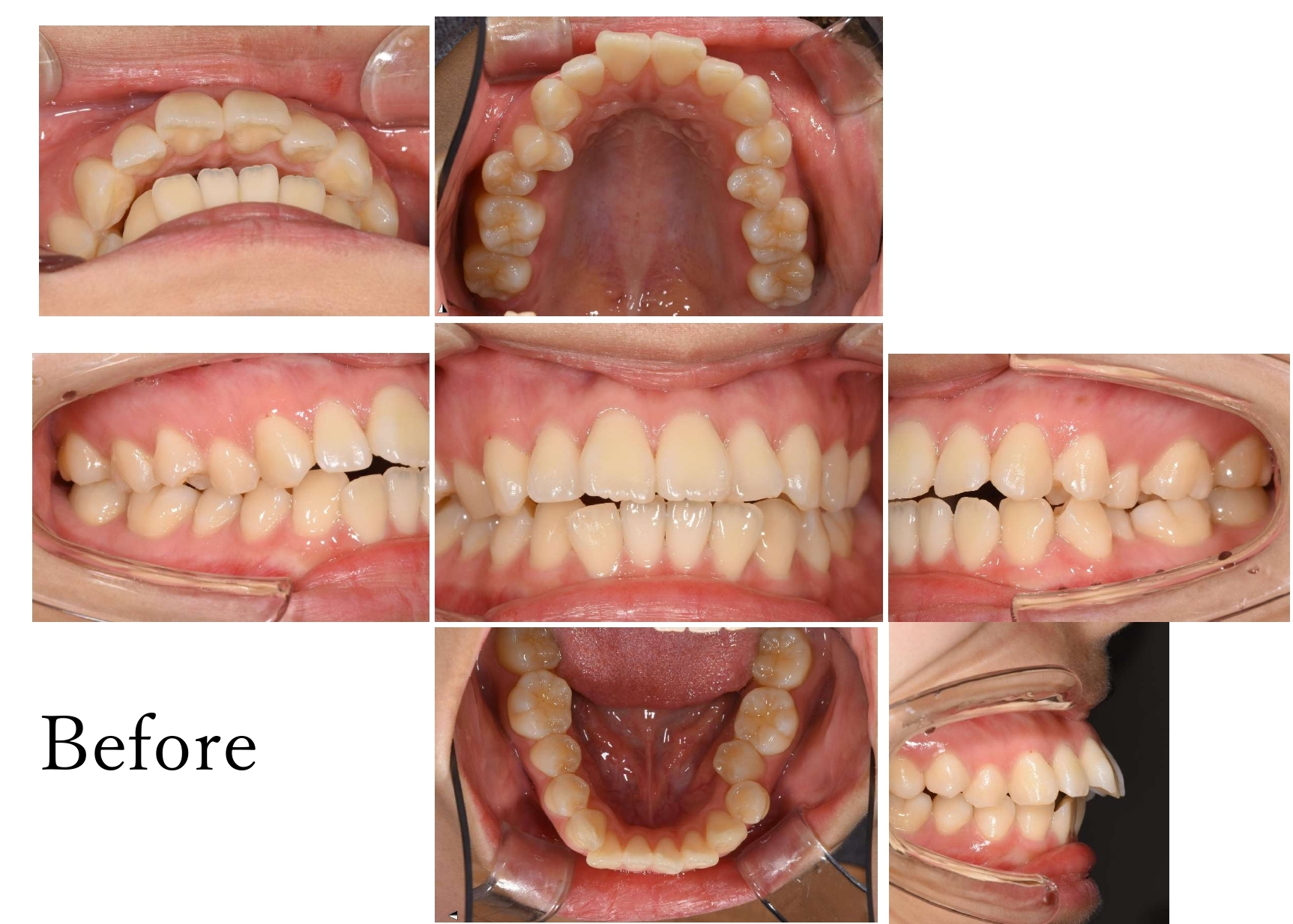 矯正治療 Before